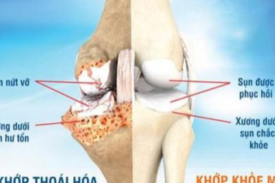 Bài thuốc làm chậm bệnh thoái hóa xương khớp