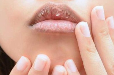 Môi khô, nứt nẻ, đau rát khó lành cảnh giác với ung thư môi