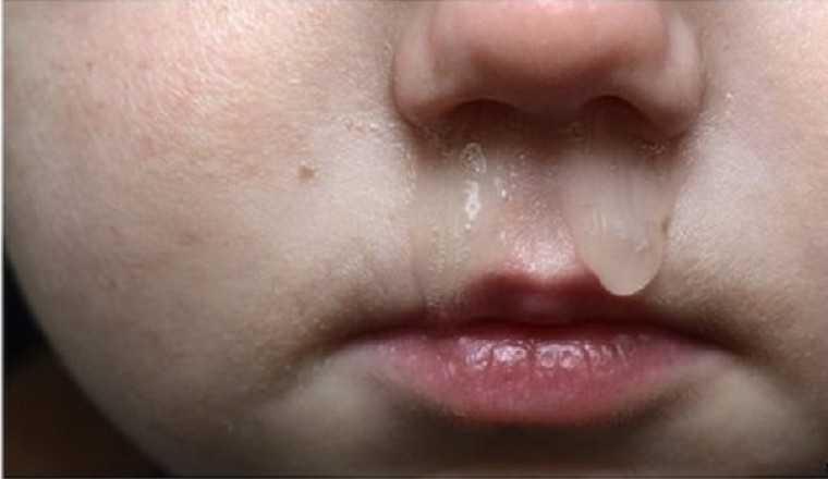 Nhiều người bị chảy nước mũi khi trời lạnh, vậy chảy mũi khi trời lạnh là bệnh gì chữa như thế nào?