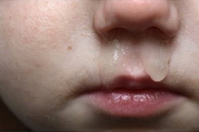 Nhiều người bị chảy nước mũi khi trời lạnh, vậy chảy mũi khi trời lạnh là bệnh gì chữa như thế nào?