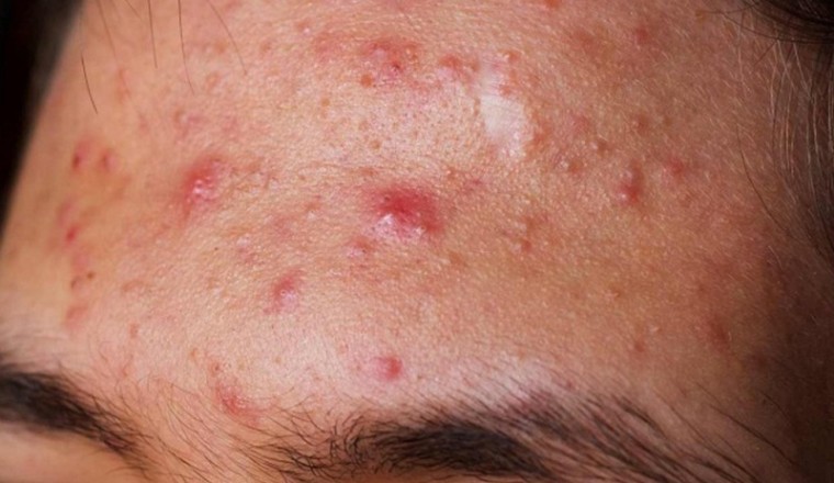 5 vị trí mọc mụn trứng cá trên mặt đang báo hiệu nhiều vấn đề sức khỏe ở tim, gan, phổi, dạ dày