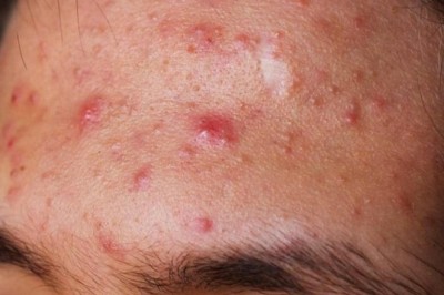 5 vị trí mọc mụn trứng cá trên mặt đang báo hiệu nhiều vấn đề sức khỏe ở tim, gan, phổi, dạ dày