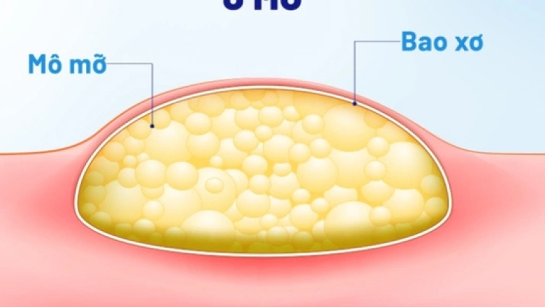 U MỠ là gì, nguyên nhân gây bệnh, lời khuyên từ bác sĩ cho người bệnh là gì?