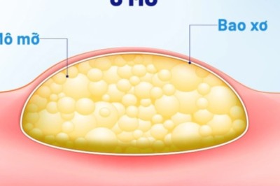 U MỠ là gì, nguyên nhân gây bệnh, lời khuyên từ bác sĩ cho người bệnh là gì?