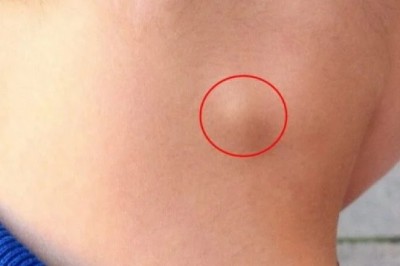 Trẻ nổi hạch như nào là bình thường, như nào là bất thường?