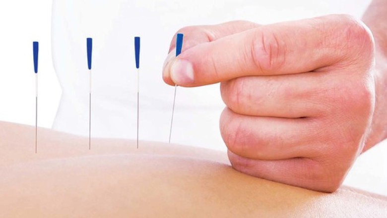 Châm cứu bấm huyệt thế mạnh của Y học Việt Nam