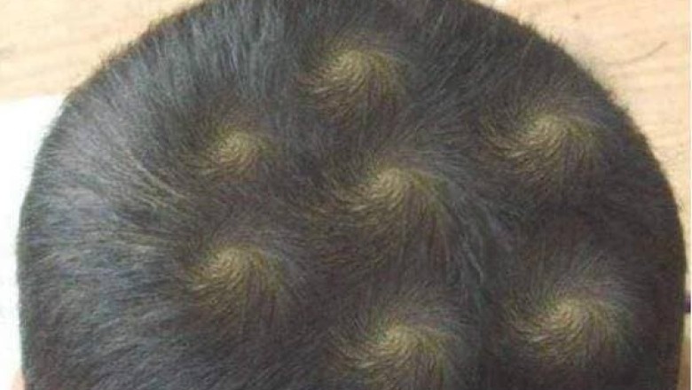 Trẻ có 2 xoáy tóc thông minh hơn? Nghiên cứu khoa học đưa ra đáp án thực sự