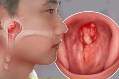 Ung thư vòm họng rất ít biểu hiện ở giai đoạn đầu đây là 5 triệu chứng dễ bỏ qua ở giai đoạn đầu nên đặc biệt chú ý