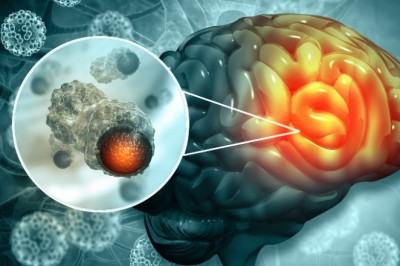 Lần đầu tiên trên thế giới chữa khỏi hoàn toàn ung thư não